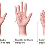 What are the Causes and Risks of Dupuytren's Contracture?