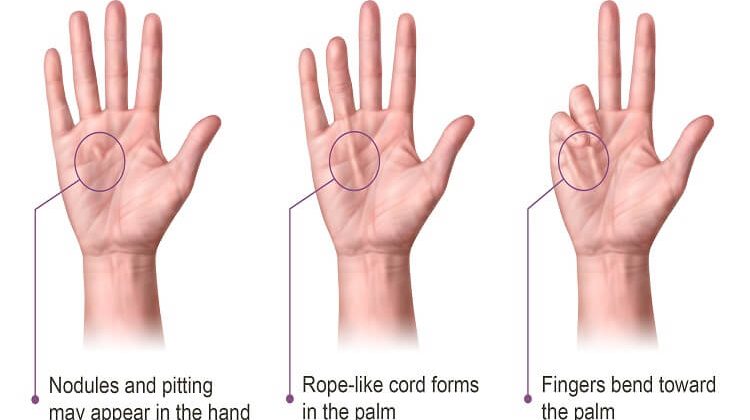 what-are-the-causes-and-risks-of-dupuytren-s-contracture-sss