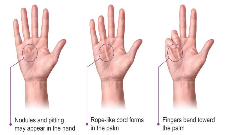 what-are-the-causes-and-risks-of-dupuytren-s-contracture-sss