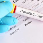 Hepatitis C: 8 Risk Factors to Avoid