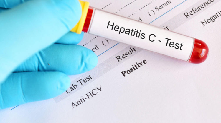 Hepatitis C: 8 Risk Factors to Avoid