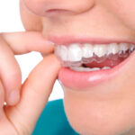 Caring for Your Retainers: Tips on Keeping Your Retainers in Good Condition